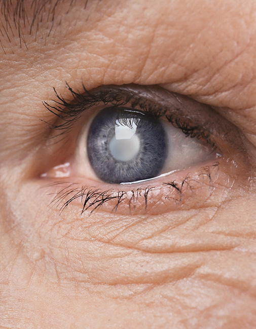 Cataract Surgery